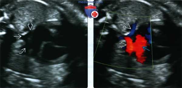 УЗИ, ЭхоКГ при тотальном аномальном дренаже легочных вен у плода