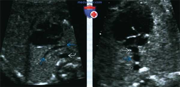 УЗИ, ЭхоКГ при тотальном аномальном дренаже легочных вен у плода