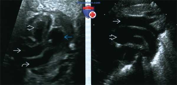 УЗИ, ЭхоКГ при транспозиции магистральных артерий у плода