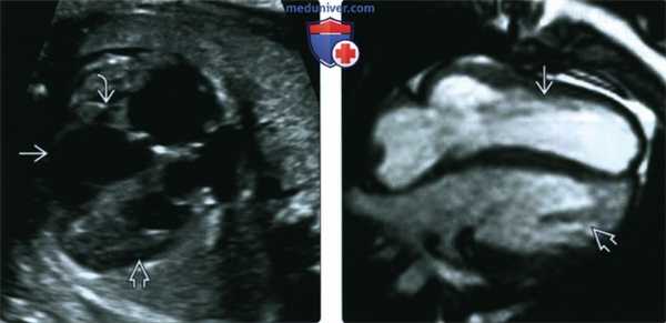 УЗИ, ЭхоКГ при транспозиции магистральных артерий у плода