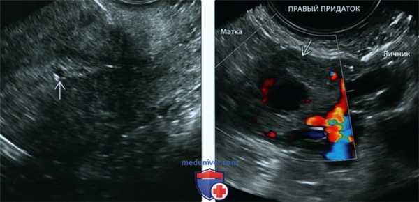 УЗИ при внематочной трубной беременности