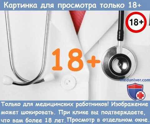 Лучевые признаки врожденной гемангиомы печени у плода