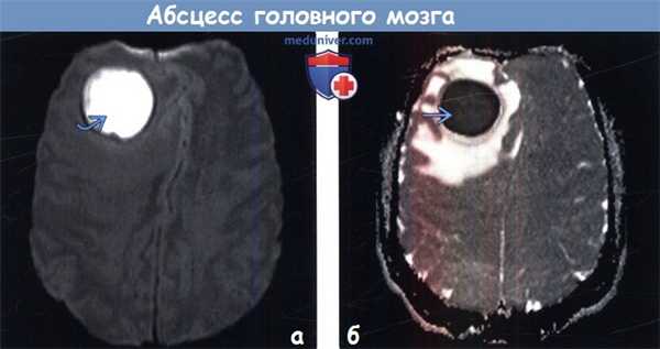 Абсцесс головного мозга на МРТ