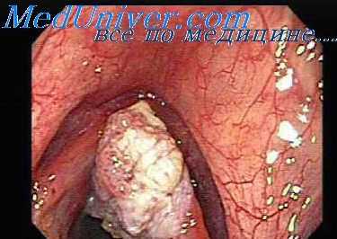 рак гортани