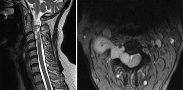 МРТ шейного отдела позвоночника в сагиттальной и аксиальной плоскостях