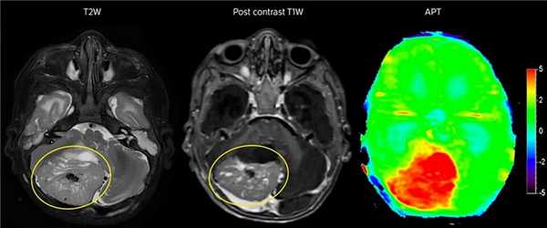 Рак головного мозга на МРТ
