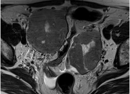 МРТ малого таза, аксиальная плоскость