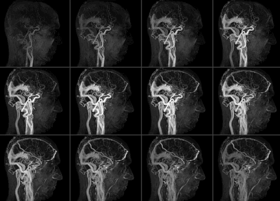 МРТ сосудов, что показывает