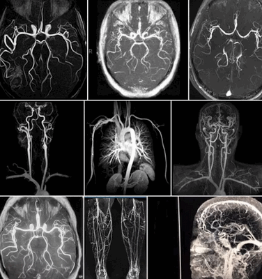 Опасно ли МРТ сосудов