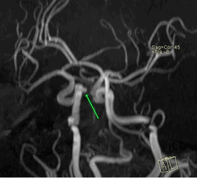 МРТ сосудов головного мозга. Мешотчатая аневризма интраклиноидного отдела правой ВСА