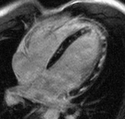 МРТ. Четырехкамерное сечение сердца. Миокардит, субэпикардиальное и интрамиокардиальное накопление контрастного препарата
