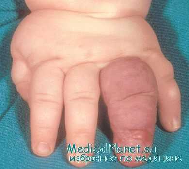 макродактилия