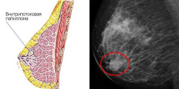 Внутрипотоковая папиллома