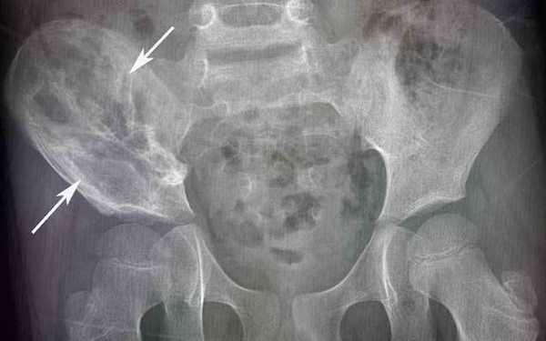 Саркома Юинга подвздошной кости