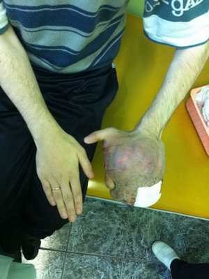 Саркома фото