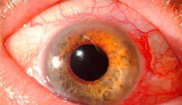 Неоваскуляризация роговицы