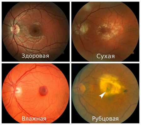 Стадии макулодистрофии