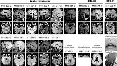 синдром жубер
