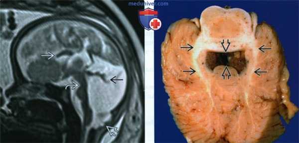 УЗИ, МРТ при синдроме Жубера у плода