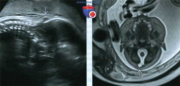 УЗИ, МРТ при синдроме Жубера у плода