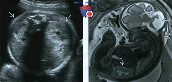 УЗИ, МРТ при синдроме Жубера у плода