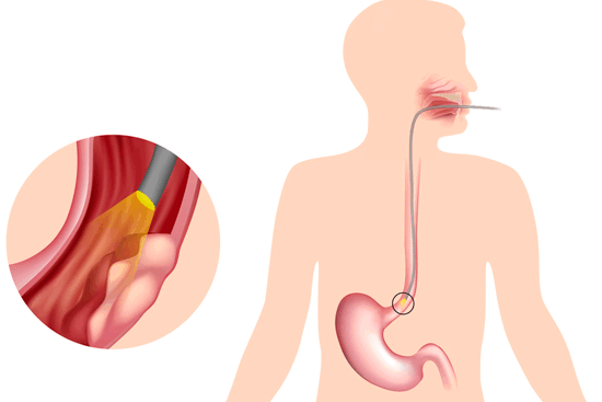 Рак пищевода с метастазами