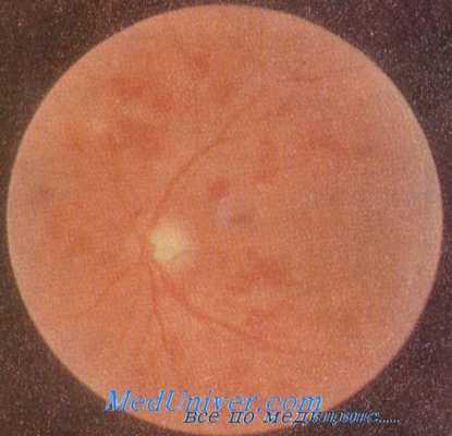 сетчатка при малярии