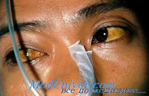 малярия глаз