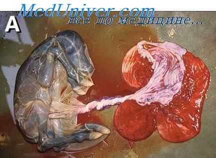 проблемы кариотипирования плода