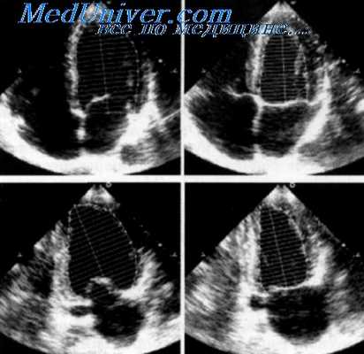 миокард левого желудочка