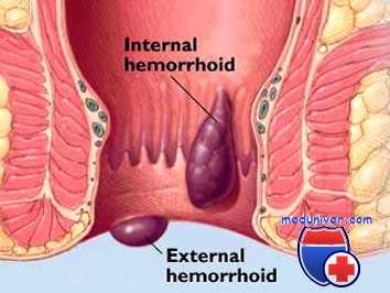 Массивное ректальное кровотечение. Источники кровотечения из ануса