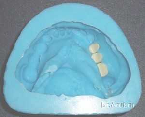 Установленные в силиконовую форму зубы