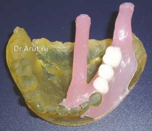 Полиуретановая модель с отлитым протезом