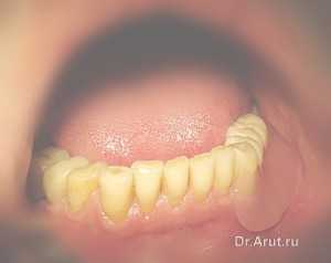 Рис. 12. Малый седловидный протез в полости рта