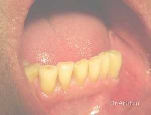 Рис. 1. Пациент Х. (односторонний концевой дефект)