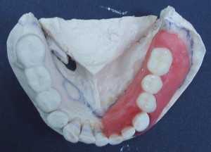 Постановка зубов