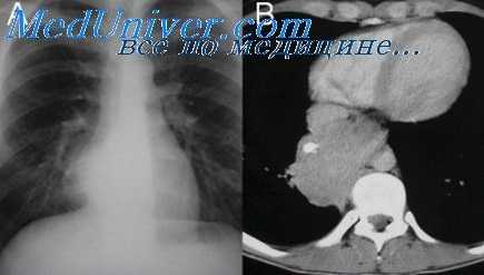 пневмопексия