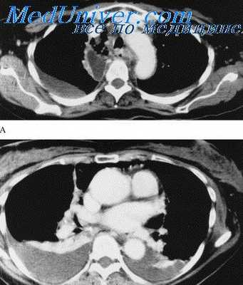 осложнения операций