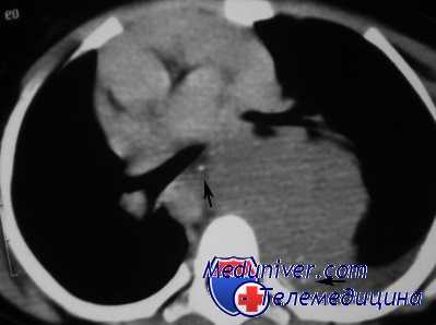 выделение легочной артерии