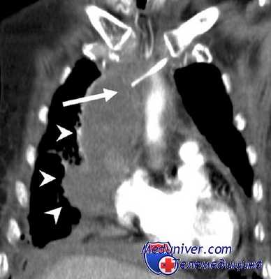 перевязка легочной артерии