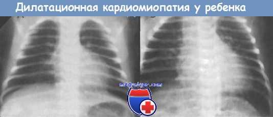 кардиомиопатия у ребенка