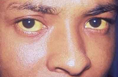 Проявление печеночной энцефалопатии