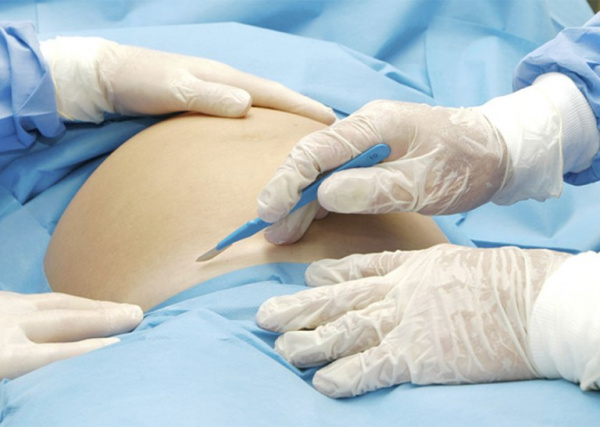 Кесарево сечение