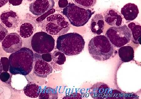 мегалобластная анемия