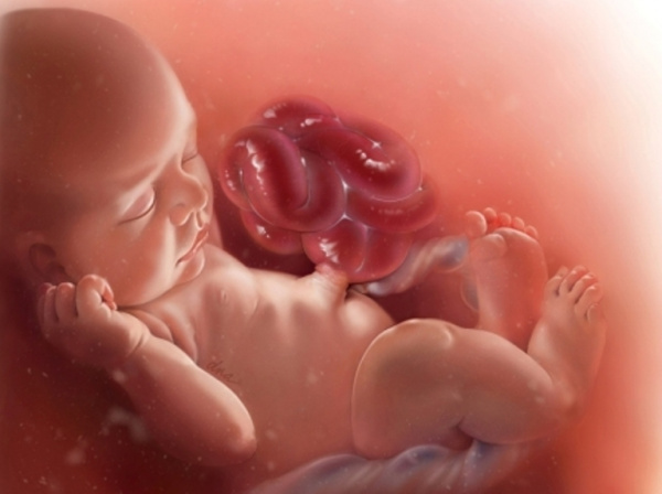 Мекониевый перитонит