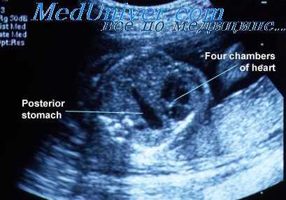 мекониевый перитонит