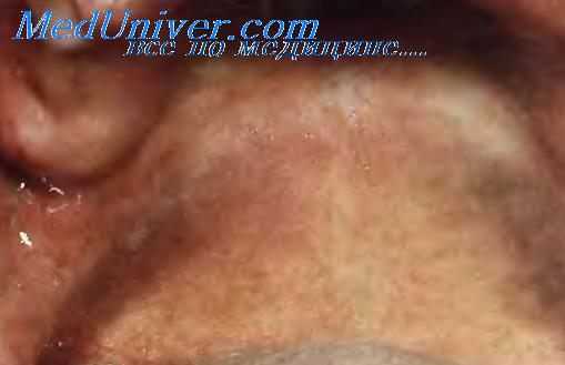 Меланоз курильщиков