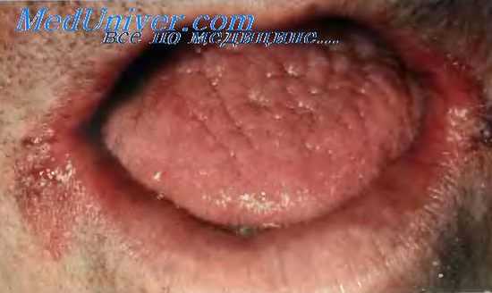 Ангулярный хейлит