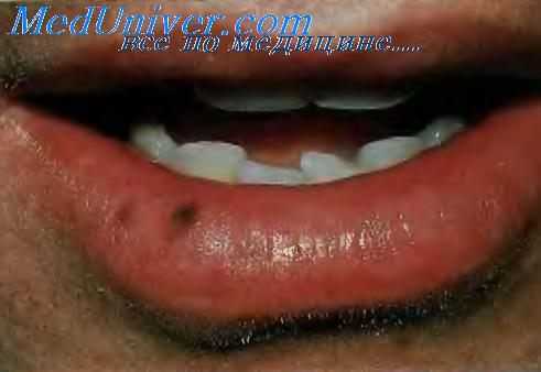 Меланома губы