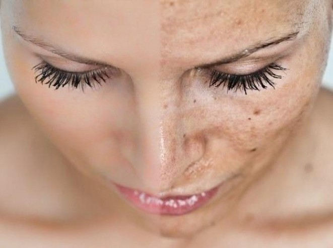 Меланоз. Причины, лечение лазером гиперпигментации кожи лица, цена